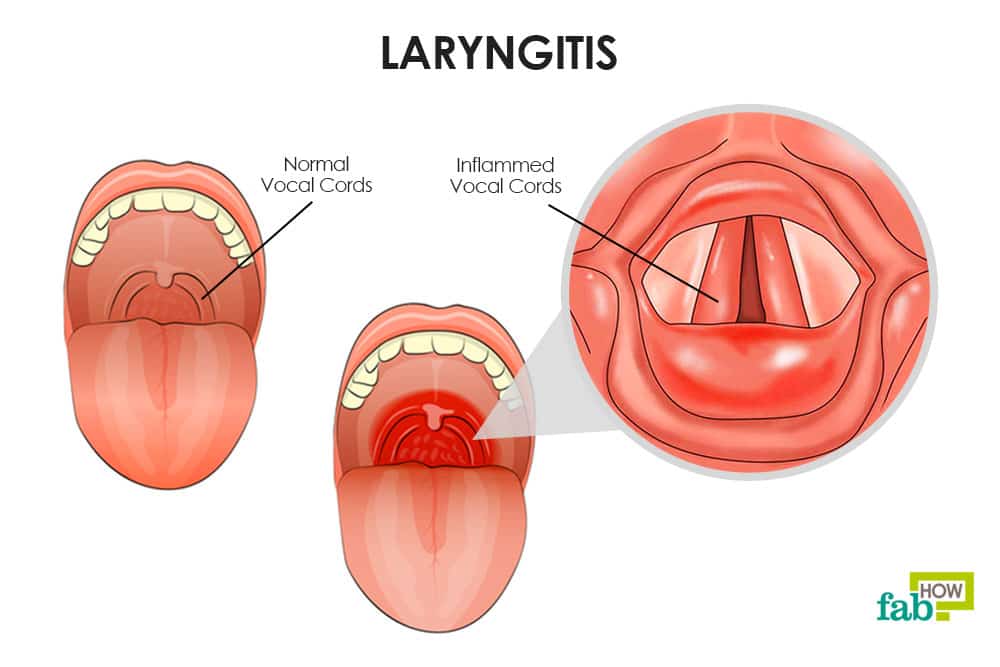 Laryngitis