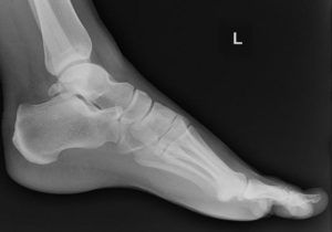 Os trigonum /os trahy-goh-nuh m/, là một cấu trúc xương nhỏ ở chân và có thể dễ chẩn đoán nhầm với gãy xương.