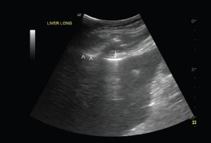 Hình 1. Khí được nhìn thấy trên mặt gan, che khuất nhu mô gan bên dưới