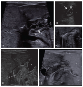 Hình 1. Hẹp phì đại môn vị trẻ sơ sinh (Infantile Hypertrophic Pyloric Stenosis)
