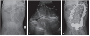 Hình 5. Tắc ruột phân su (Meconium ileus) – Hội chứng tắc ruột đoạn xa (distal intestinal obstruction syndrome – DIOS)