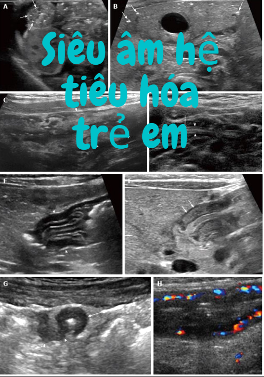 Siêu Âm Hệ Tiêu Hóa Trẻ Em (Sonography of the Pediatric Gastrointestinal System)