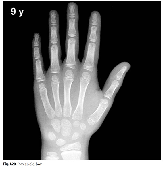 Examples Of Left Hand Bone Age Ba Radiographs From Fo vrogue.co
