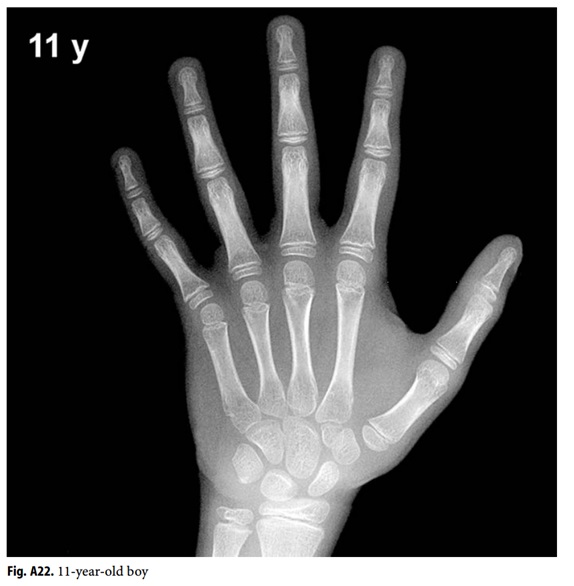 Anhvanyds - Hand Bone Age (Tuổi xương bàn tay)