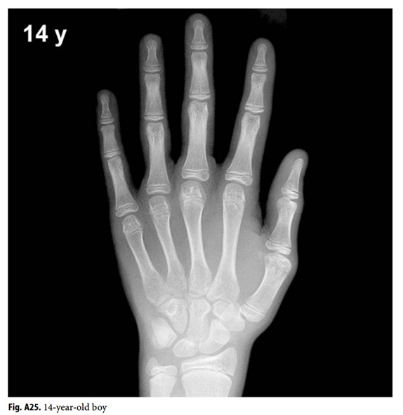 Anhvanyds Hand Bone Age (Tuổi xương bàn tay)