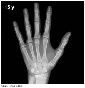 Anhvanyds - Hand Bone Age (Tuổi xương bàn tay)