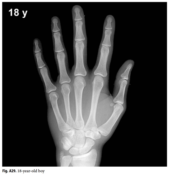 Anhvanyds - Hand Bone Age (Tuổi xương bàn tay)