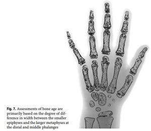 Anhvanyds - Hand Bone Age (Tuổi xương bàn tay)