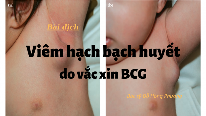 Bài dịch: Viêm hạch bạch huyết do vắc xin BCG