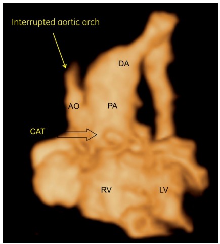 Thân chung động mạch (CAT, mũi tên trong) type A4