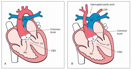 Sơ đồ hình vẽ của thân chung động mạch (CAT) type 1 (A) và type A4 (B)