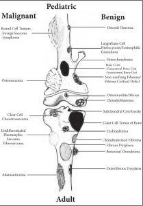 Hình: vị trí của các khối u xương thường gặp ở trẻ em và người lớn