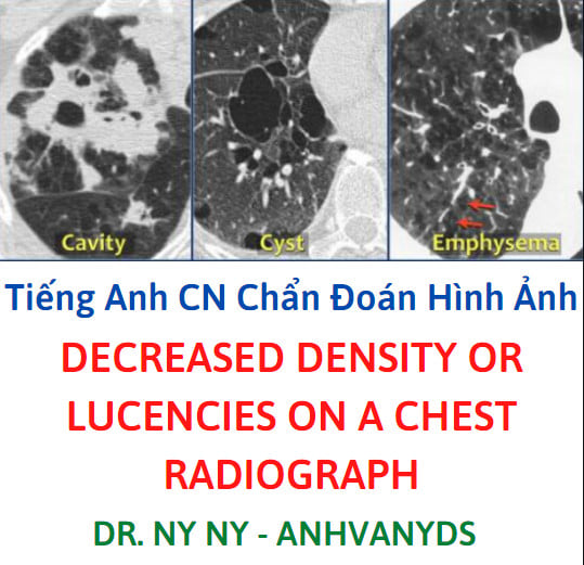  tổn thương giảm đậm độ ở phổi 