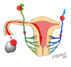 Figure 1: endometriosis modes of spread -  các kiểu lây lan của lạc nội mạc tử cung