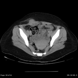 Case 14: involving abdominal wall – liên quan đến thành bụng
