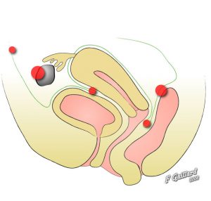 Figure 3: endometriosis distribution –  sự phân bố của lạc nội mạc tử cung