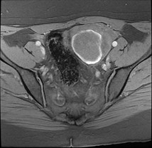Case 1: endometrioma T1 FS – U lạc nội mạc tử cung trên T1 xóa mỡ