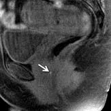 Case 8: rectovaginal septal nodule –  nốt ở vách ngăn trực tràng-âm đạo