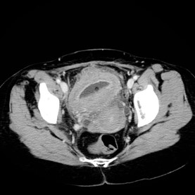 Case 9: involving bladder – liên quan bàng quang