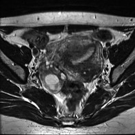 Case 11: involving right ovary –  liên quan đến buồng trứng bên phải