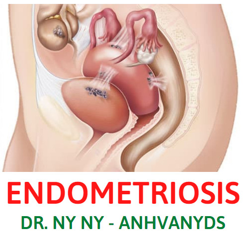 Lạc Nội Mạc Tử Cung (Radiographic Features Of Endometriosis) qua CĐHA
