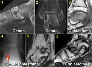 Hình 19. Một số ví dụ điển hình của các khối u xương ở bàn chân.