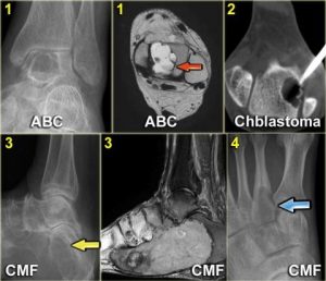 Hình 20. một số ví dụ khác về các khối u xương ở bàn chân.