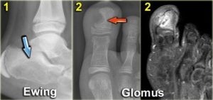 Hình 21. một số ví dụ khác về các khối u xương ở bàn chân.
