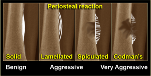 Phản ứng màng xương (Periosteal reaction) trong chuẩn đoán u xương