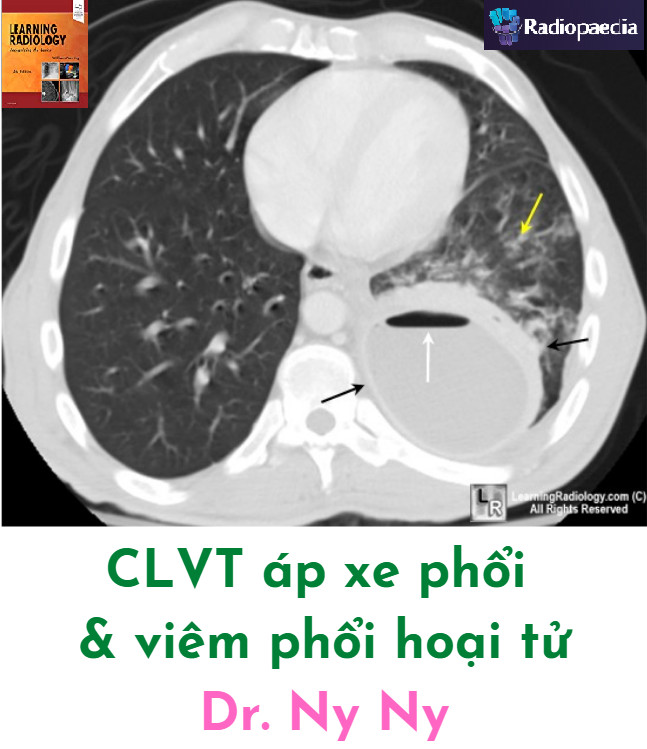 Chẩn đoán hình ảnh áp xe phổi (Lung Abscess) và viêm phổi hoại tử (Necrotizing pneumonia)