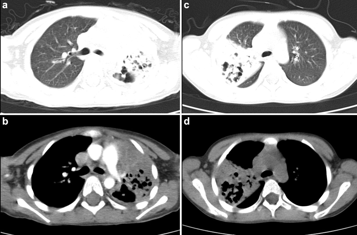 Diagnostic imaging of lung abscess (Lung Abscess) and necrotizing