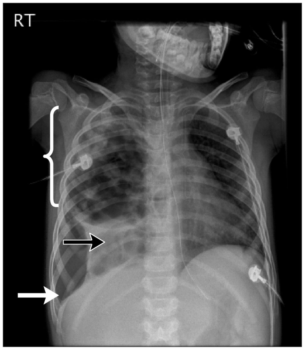 Diagnostic imaging of lung abscess (Lung Abscess) and necrotizing ...