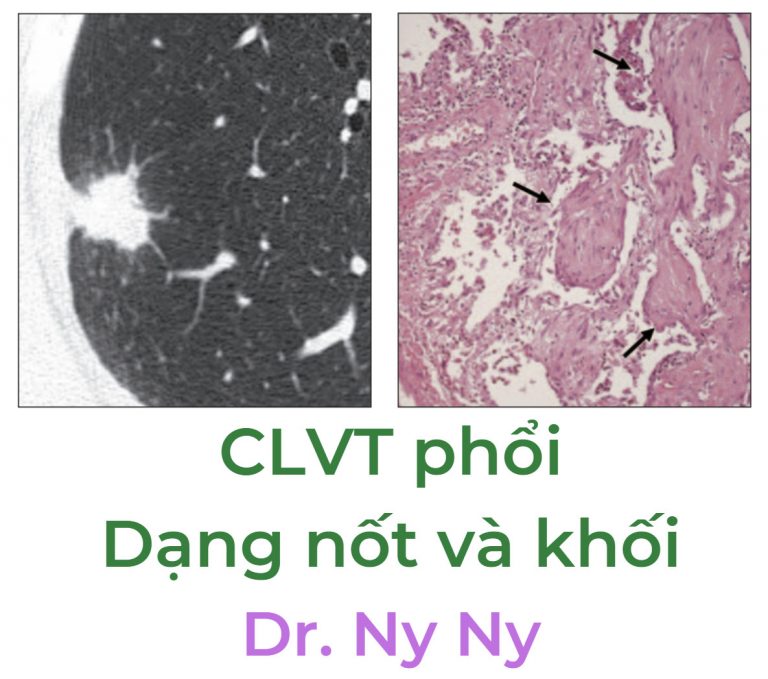 Cắt lớp vi tính phổi: Các tổn thương giống với ung thư phổi — Các đặc điểm trên CT với mối tương quan bệnh học (Lung CT: Mimickers of Lung Cancer—Spectrum of CT Findings with Pathologic Correlation)