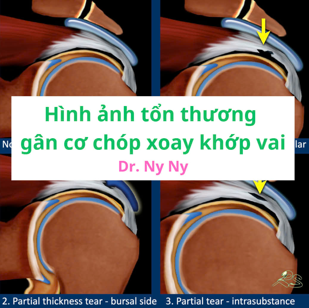 Anhvanyds - Tổn thương gân cơ chóp xoay khớp vai (Shoulder Rotator cuff ...